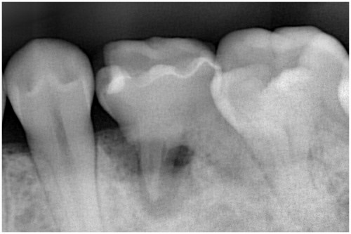 阿久井２　乳歯根吸収